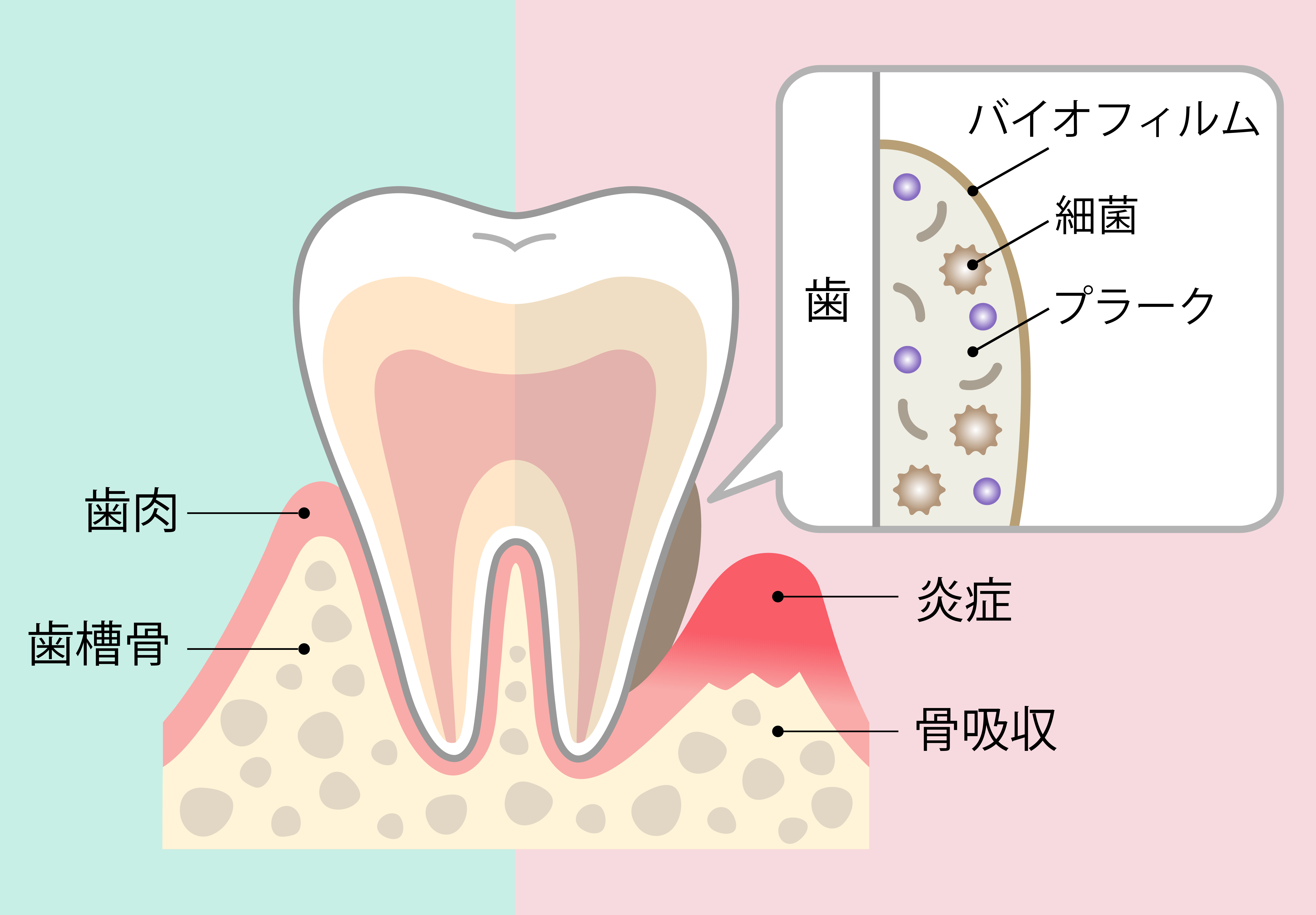 歯石除去には、歯のクリーニングが必要です！